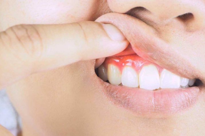 5 Symptoms of Gum Disease and How To Treat It