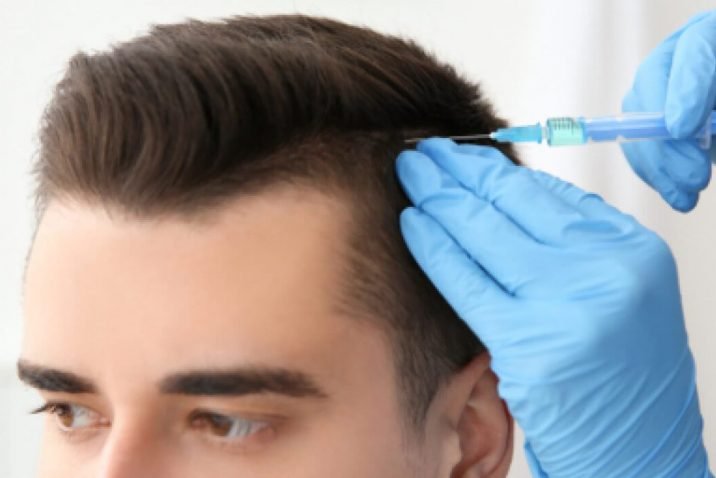 Hair transplant