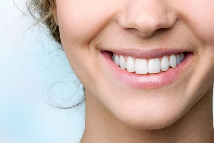 How Durable Are Porcelain Veneers