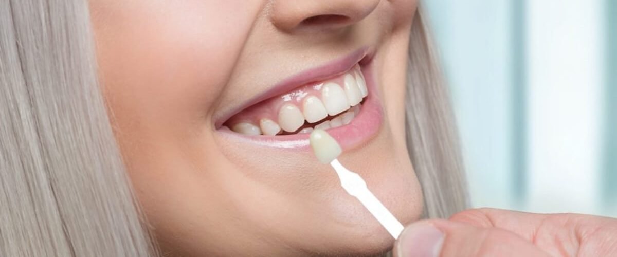 Are Veneers Harmful To Tooth