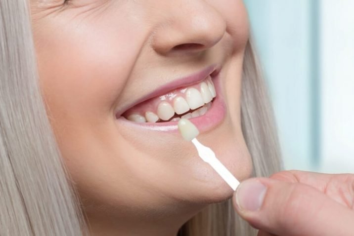 Are Veneers Harmful To Tooth