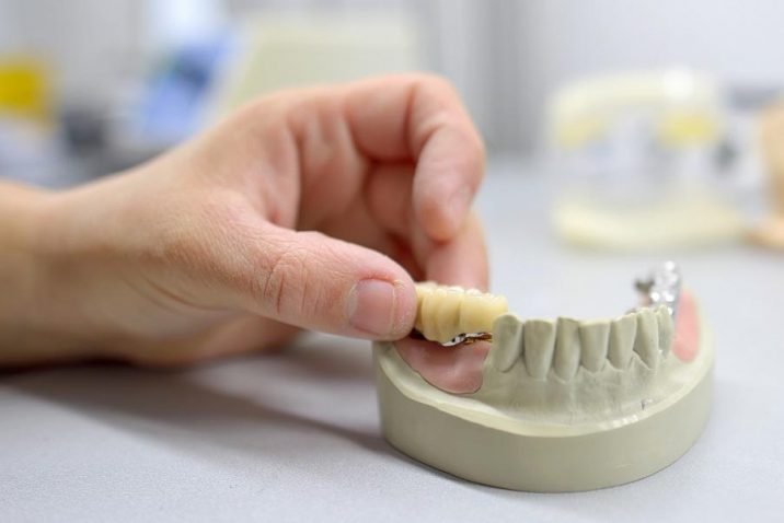 How Long Does It Take To Get To Get Dental Bridge