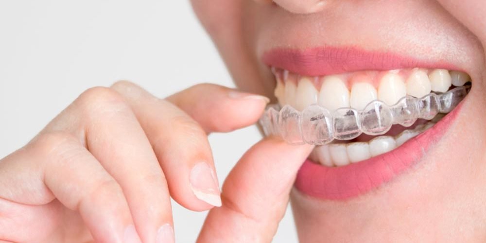 4 Reasons Why You Need Braces