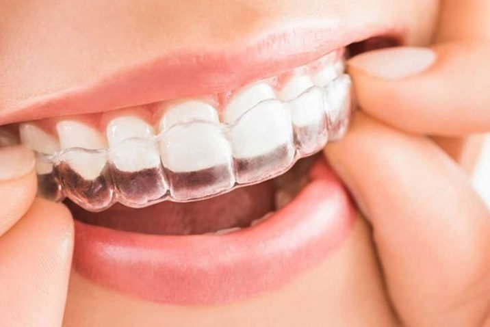 Invisalign Aligners