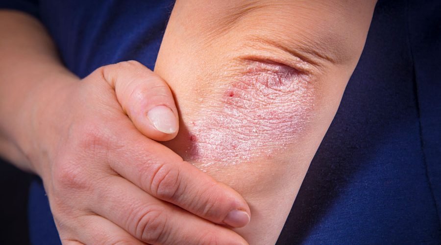 Skincare For Psoriasis & Eczema Sufferers