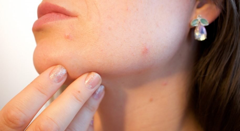 How to Treat Inflamed Acne Naturally_ Practical Tips-1