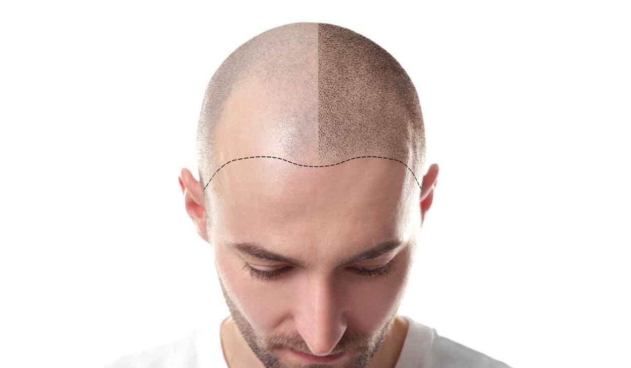 The Best Immediate Solution For Male Pattern Baldness 1