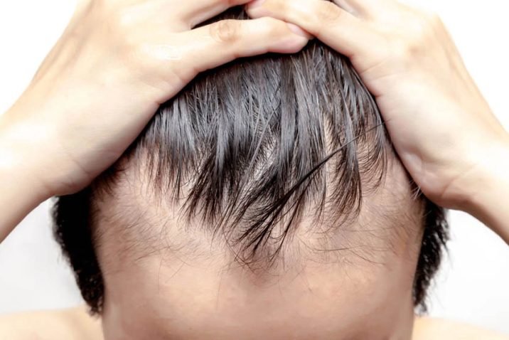 The Best Immediate Solution For Male Pattern Baldness