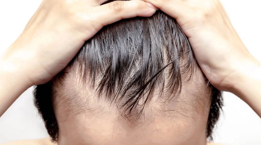 The Best Immediate Solution For Male Pattern Baldness
