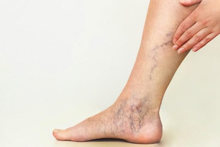Vascular Disease of the Legs Treated