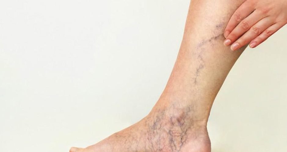 Vascular Disease of the Legs Treated